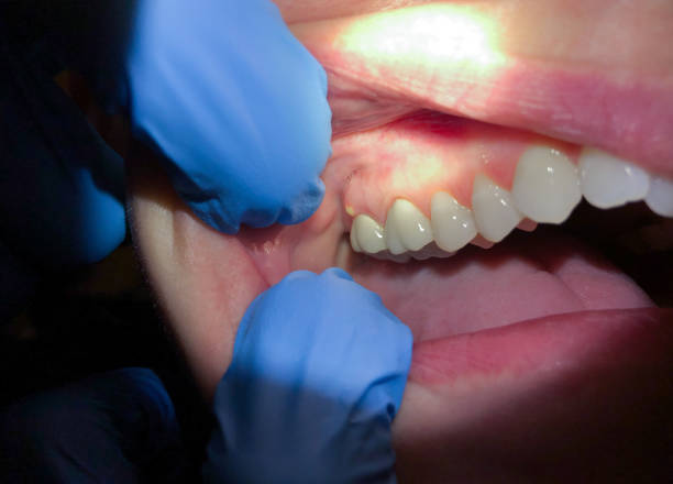 Best Emergency Dental Care for Broken or Chipped Teeth in Lawson Heights, PA
